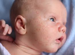 Mostly baby fat is around the belly area but during the long 9 month period, it also hangs around through your faces as well. Baby Acne Symptoms How To Treat Baby Acne On Face
