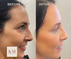 ✨ Beautiful results for a beautiful patient! ✨ We used Dysport to soften  fine lines and dermal filler to add subtle lift and contour to her cheeks.  The result? A refreshed, natural