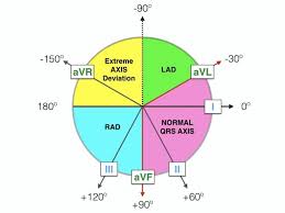 Ecg Axis Interpretation Litfl Medical Blog Ecg Library