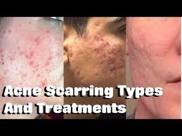 Treating mild acne naturally with acnease herbal supplements. How To Treat Acne Scarring Remove Mild Moderate Severe Acne Scars Youtube