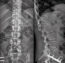 Almost files can be used for commercial. Compression Fracture Of A Lumbar Vertebra Photograph By Zephyr Science Photo Library