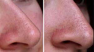 Thanks to photoshop and facetune, many of us have been a desire to tighten pores is one of the most common treatments patients seek from dermatologists. Pin On Facial Masks For Pores