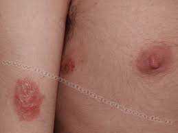 Image result for Eczema nummulare