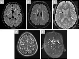 Image result for Incidental Imaging Finding