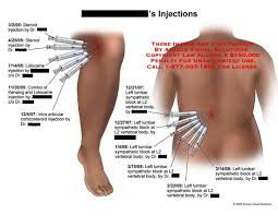 Image Result For Intra Articular Injection Sites Injections Lidocaine Steroids