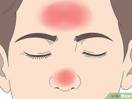 Nasal polyps are soft, painless, noncancerous growths lining the nose or sinuses. 3 Ways To Cure Nasal Polyps Wikihow