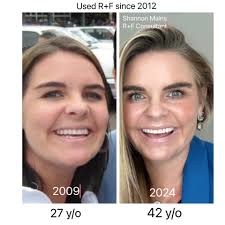 Daisy's story is my most favorite out of all the RF transformations ❤️😍  Think you're too old to achieve great skin results⁉️ Think you're too old  to start a business⁉️ This is