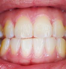 How much does zoom whitening cost. Teeth Whitening At The Dentist Procedure Cost