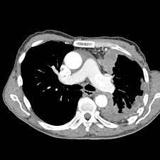 Hemoptysis is the spitting of blood that originated in the lungs or. Mesothelioma Image Radiopaedia Org