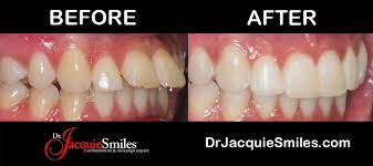 Correcting a severe overbite or overjet. Invisalign Clear Aligners Vs At Home Teeth Straighteningdr Jacquie