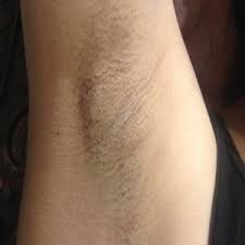 98% of velvet skin customers recommend this device to their friends How To Effectively Treat This Laser Hair Removal Burn Underarm In Order To Heal Fast And Prevent Pigmentation Changes Photo