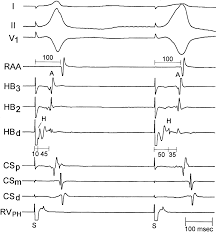 Para-Hisian Pacing