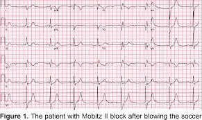 Atrioventricular block // msd manual. Figure 1 From The Frequency Of Type 2 Second Degree And Third Degree Atrioventricular Block Induced By Blunt Chest Trauma In The Emergency Department A Multicenter Study Semantic Scholar
