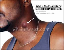 The stage at diagnosis is the major determinant of the chance for later spread (metastasis). What Is The Prognosis For Merkel Cell Carcinoma