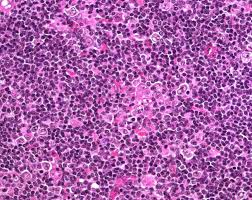 Nodular Lymphocyte Predominant Hodgkin Lymphoma Humpath Com Human Pathology