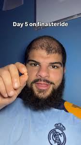 The main side effects I've had starting finasteride... follow for more  updates! 🫡