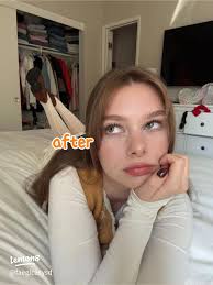 My Transformative Acne Journey with Azelaic Acid