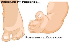 Image result for Clubfoot