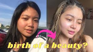 RHINOPLASTY, CHIN AUGMENTATION AND BUCCAL FAT REMOVAL BY DOC MARLON LAJO