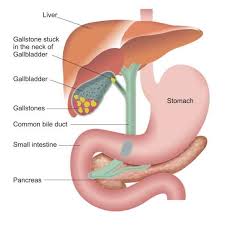 Image result for Gallstone