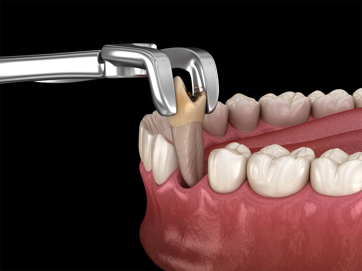 TOOTH EXTRACTION product image