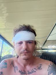 Severe Skateboarding Injury and Safety Discussion