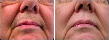 Best laser hair removal chicago il rinu gour medium. We Are Using Advanced Techniques And Modern Tools To Remove Hairs From Your Body P Laser Hair Removal Brazilian Laser Hair Removal Permanent Laser Hair Removal