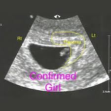 Jika melihat sepintas foto usg itu, kamu pasti hanya akan melihat janin yang tertidur manis di dalam janin sang ibu. Ini Salah Satu Cara Mengetahui Ciri Hamil Anak Perempuan Trimester 2 Semua Halaman Nakita