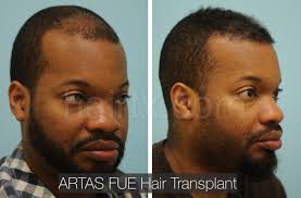 Hair transplant surgery can be a very rewarding experience. Ethnic Hair Restoration Dallas Ethnic Hair Surgery Plano Tx