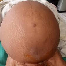 Ovarian cancer is misdiagnosed as cyst and ovarian cysts are often mistaken for ovarian cancer. Giant Ovarian Cyst Masquerading As A Massive Ascites A Case Report Bmc Research Notes Full Text