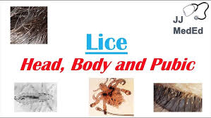 Image result for pubic lice symptoms