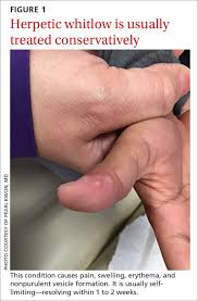 Herpes simplex virus type 2. How Best To Approach These Acute Hand Infections Mdedge Family Medicine