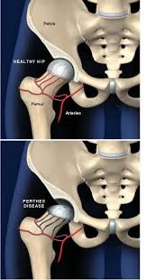Image result for Perthes Test