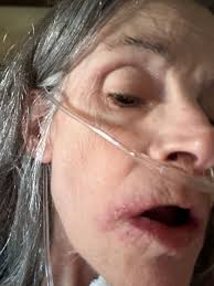 What can I use to relieve itchy skin and red bumps around my nose and  eyelids?