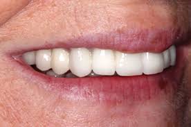 These stains are generally yellow in color, although they can also be the color of whatever you ate or drank. Treatment Of Tetracycline Discoloured Teeth With Full Ceramic Restorations