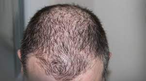 In more severe cases, this may lead to hair loss. Does Iron Deficiency Lead To Hair Fall From Eggs To Spinach Foods One Must Eat For A Healthy Scalp Latestly