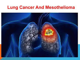 Breathing high levels of asbestos can lead to mesothelioma or lung cancer. Lung Cancer And Mesothelioma Causes