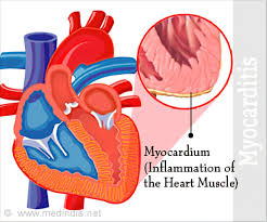 Heart muscle inflammation (myocarditis) is an inflammatory process of the heart muscle, which can be acute or chronic in nature. Myocarditis Types Causes Symptoms Complications Treatment Prognosis