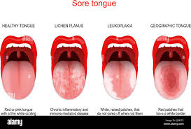 Image result for lichen planus on tongue)