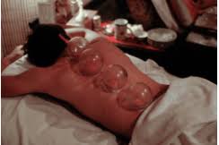 Compare kitchen & dining products. Cupping Therapy Is It Worth The Bruises Bmeg442 Engineering Exercise And Sports