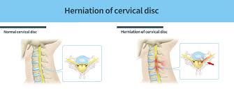 Image result for Lower Cervical Intramuscular Injection