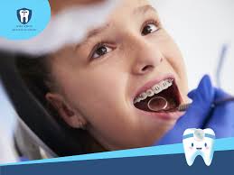 Mắc cài tự buộc và mắc cài thường kim loại giống và khác nhau thế nào?