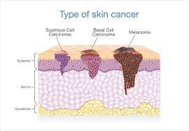 This information is about symptoms of the common types of skin cancer, called basal cell carcinomas (bccs) and squamous cell carcinomas (sccs) of the skin. Dermasensors The Future Of Skin Cancer Detection