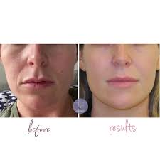 Mid-Face Volume, Radial Smile Line Ferning, and Lip Filler Correction 💉❤️,  ., Yes, I know there’s totally different lighting here. Please, don’t come  for me 🏳️🙏 Unfortunately this is our only before ...