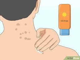 Apply honey on the scars and leave it overnight. 3 Ways To Get Rid Of Back Acne Scars Wikihow