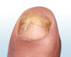 Nagelpilz Definition Erreger Symptome Bilder Ciclopoli