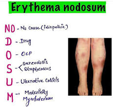 Image result for erythema nodosum