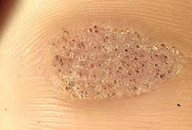 Want to discover art related to foot_worship? Plantar Warts Picture Image On Medicinenet Com