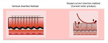 Es gibt dermaroller mit verschiedene nadellängen, angefangen bei 0,2 millimetern bis hin zu 3 millimetern. Dermaroller Oder Dermastamp Das Sind Die Unterschiede
