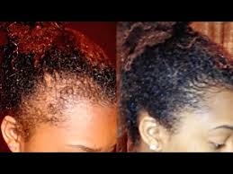 Magda ryczko, owner of hairrari salon, recommends treating thinning hair with any shampoo with minoxidil, which she describes as a chemical that regrows hair this is dying. How To Regrow Your Edges Bald Spots And Thinning Hair Youtube
